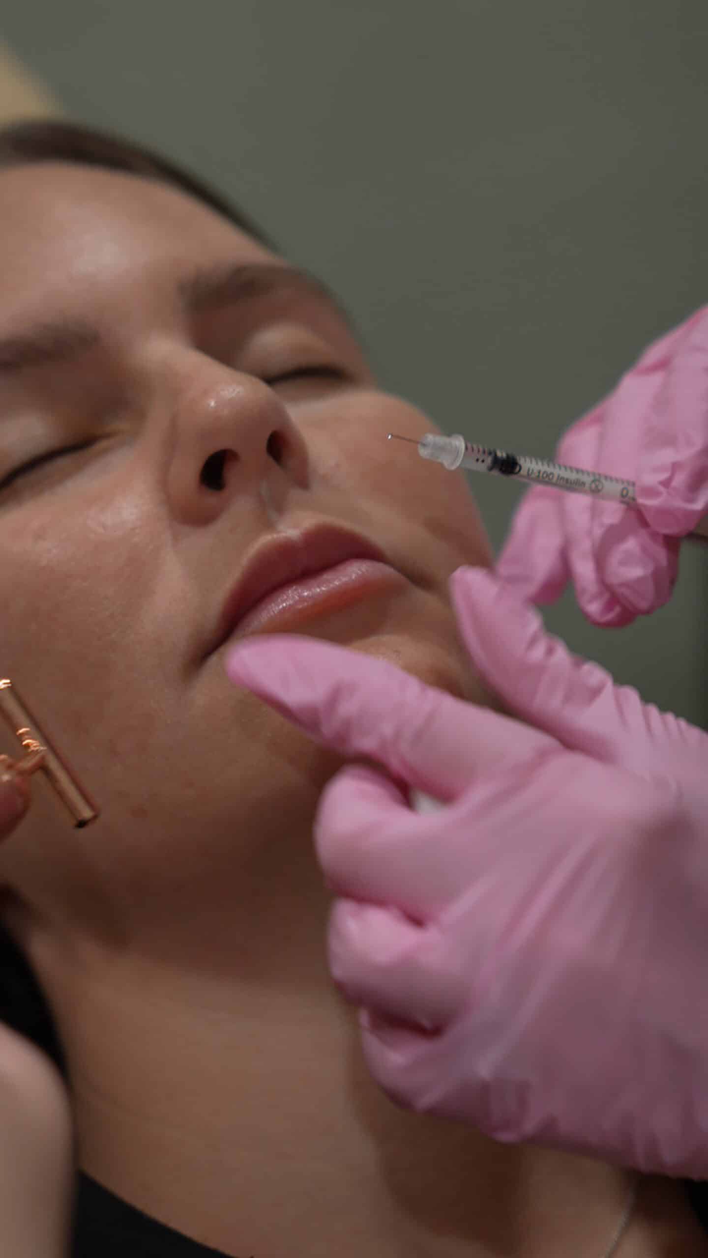 Fillers treatment at White Coat Glam Miami