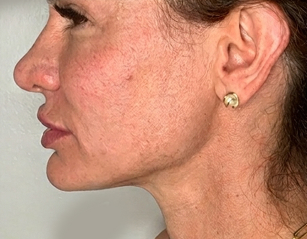 Endolift jawline results at White Coat Glam Miami